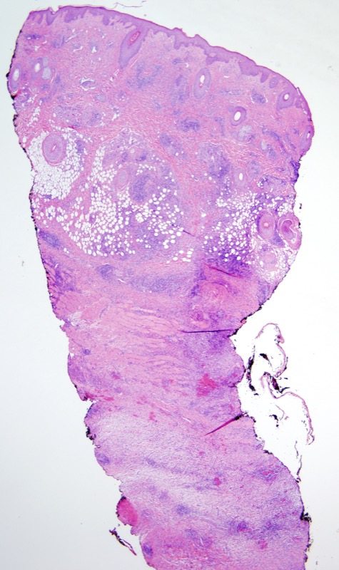 Slide 1: 40 year old man presenting with fever and a scalp lesion 2 weeks after traveling to Guatemala. <br><br>The excision specimen extends to the subcutaneous fat.  There is an extensive inflammatory process involving the entire thickness of the biopsy and sparing of the epidermis.