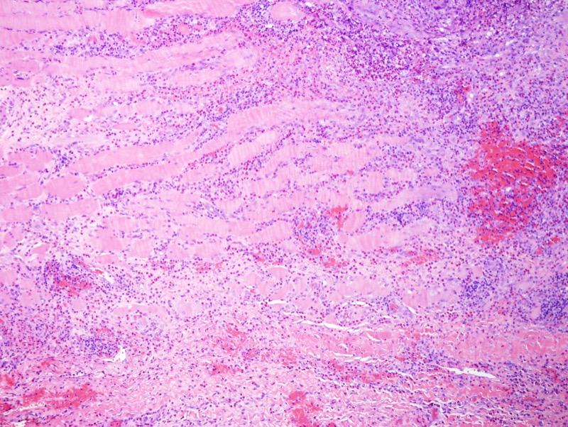 Slide 3: There is marked infiltration of the fat defining what is in essence a lymphocytic and eosinophilic panniculitis.  There is marked infiltration of the skeletal muscle by eosinophils.