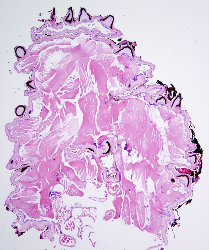 Slide 5: The larva is very distinctive exhibiting a thin cuticle from which emanate distinct eosinophilic spines.  There is extensive skeletal muscle.