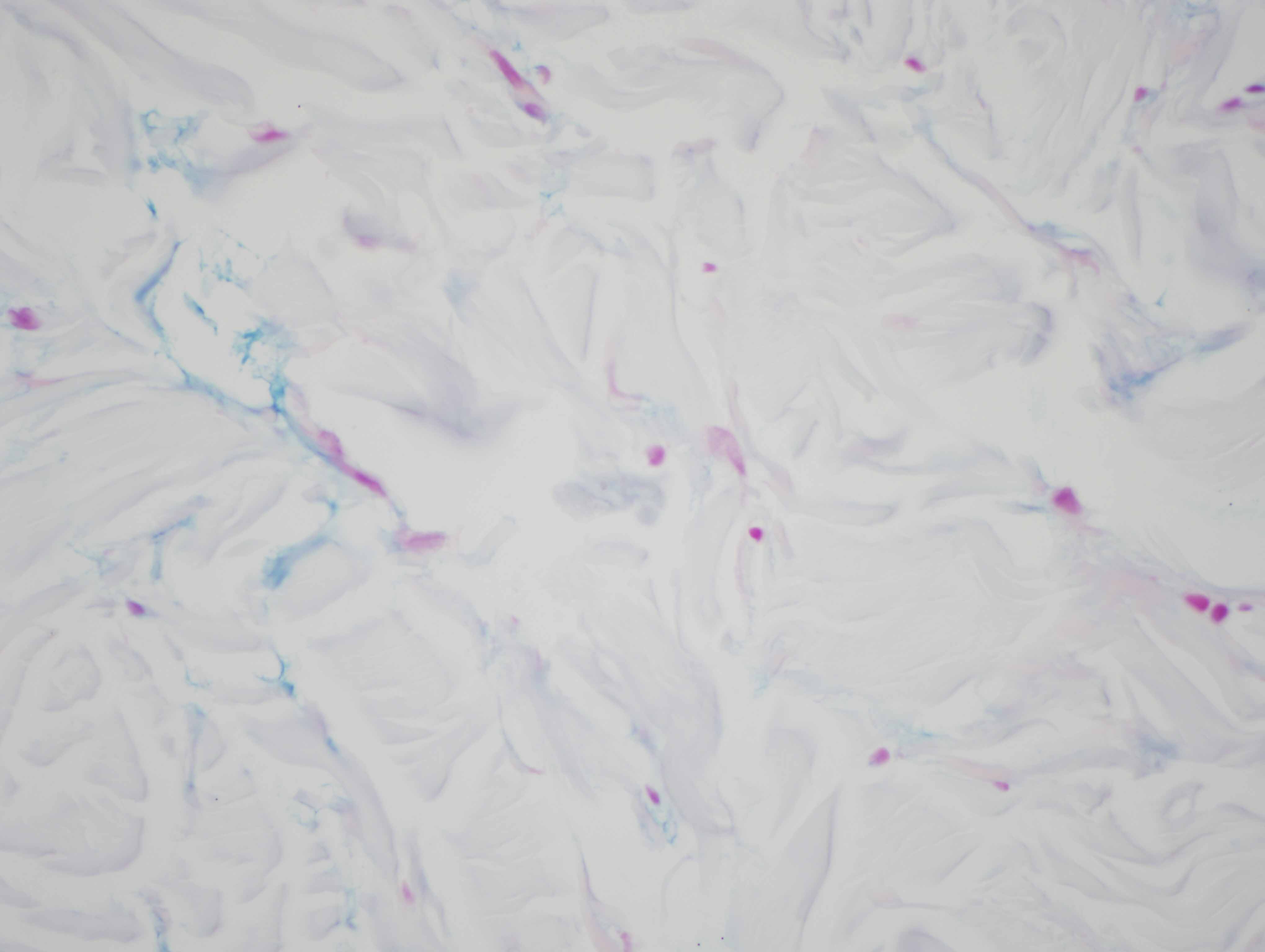 Slide 8: The Alcian blue stain shows areas of moderate interstitial mucin deposition.