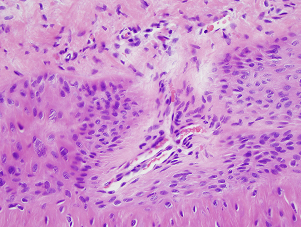 Slide 3: There is some element of random cellular atypia amidst this matrical epithelium as characterized by cells that exhibit significant nuclear enlargement with nuclear hyperchromasia, bi and multinucleation with perinuclear halos accompanied by some hypereosinophilic condensation of the cytoplasm at the periphery of the cell suggesting koilocytic effect.