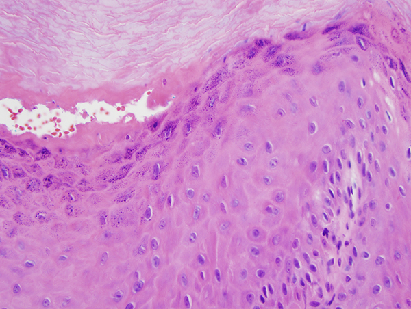 Slide 4: While there is this interesting pattern of cellular atypia, diagnostic features of carcinoma are not seen.