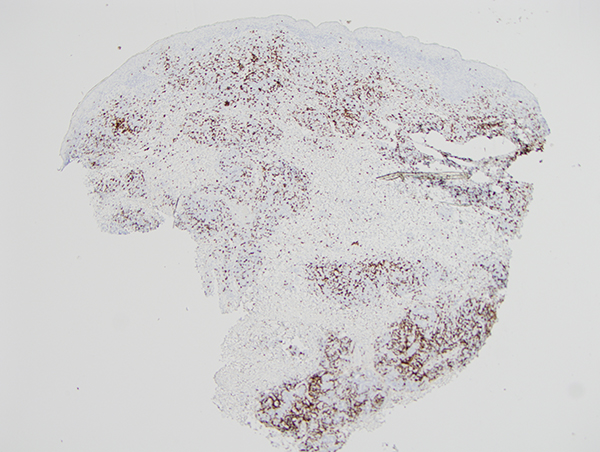 Slide 6: Many of the malignant cells are positive for CD5 but there is a significant decrement in staining for CD2 (pictured); the majority of the malignant lymphocytes do not stain positively for CD2.