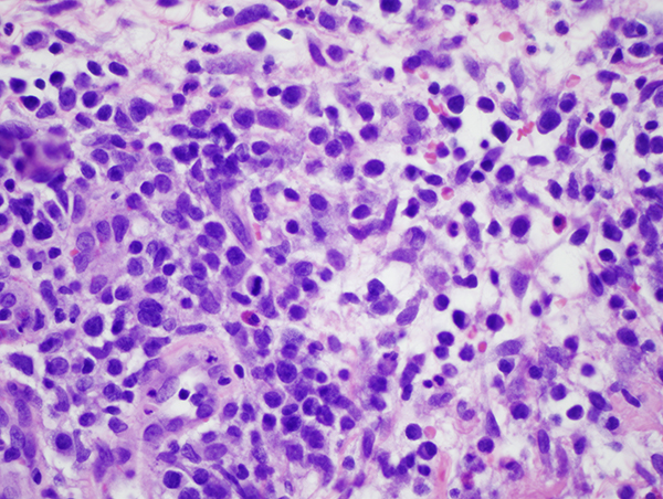 Slide 5: When one examines the nodular vasocentric foci of neoplastic lymphocytic infiltration many of the lymphocytes have an immunoblastic appearance. They are in the 15-20 micron size range, showing a finely dispersed chromatin with conspicuous nucleolation. In any one high power field focusing a few of the nodular infiltrates are predominated by larger atypical non-cerebriform lymphocytes although overall the percent of large atypical cells is not more than 30%(roughly 25% realm).