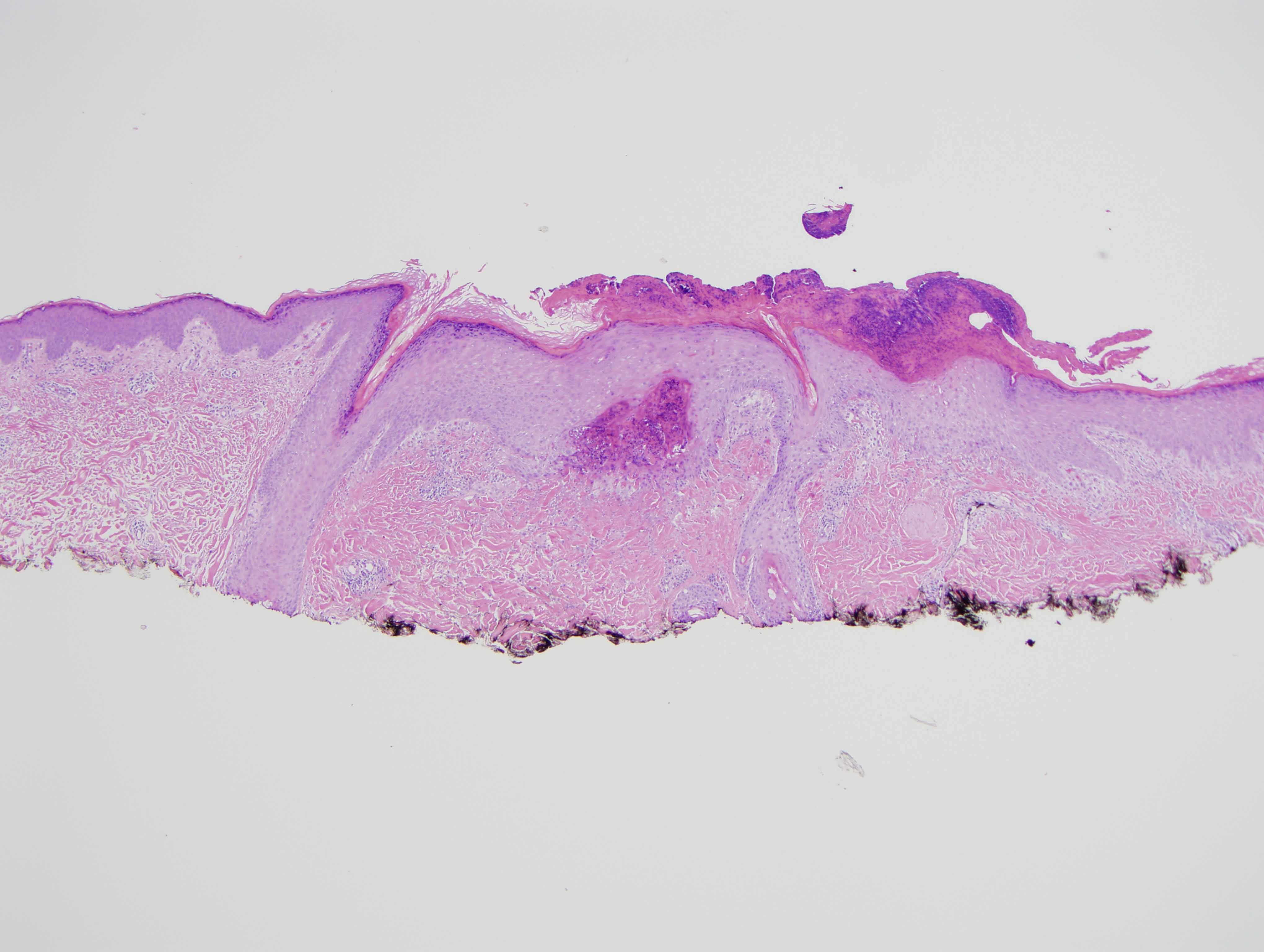 Slide 1: The biopsy shows an area of trauma whereby the epidermis is surmounted by a scale that is heavily imbued with neutrophils and fibrin. There is subepidermal fibrosis and hemorrhage.