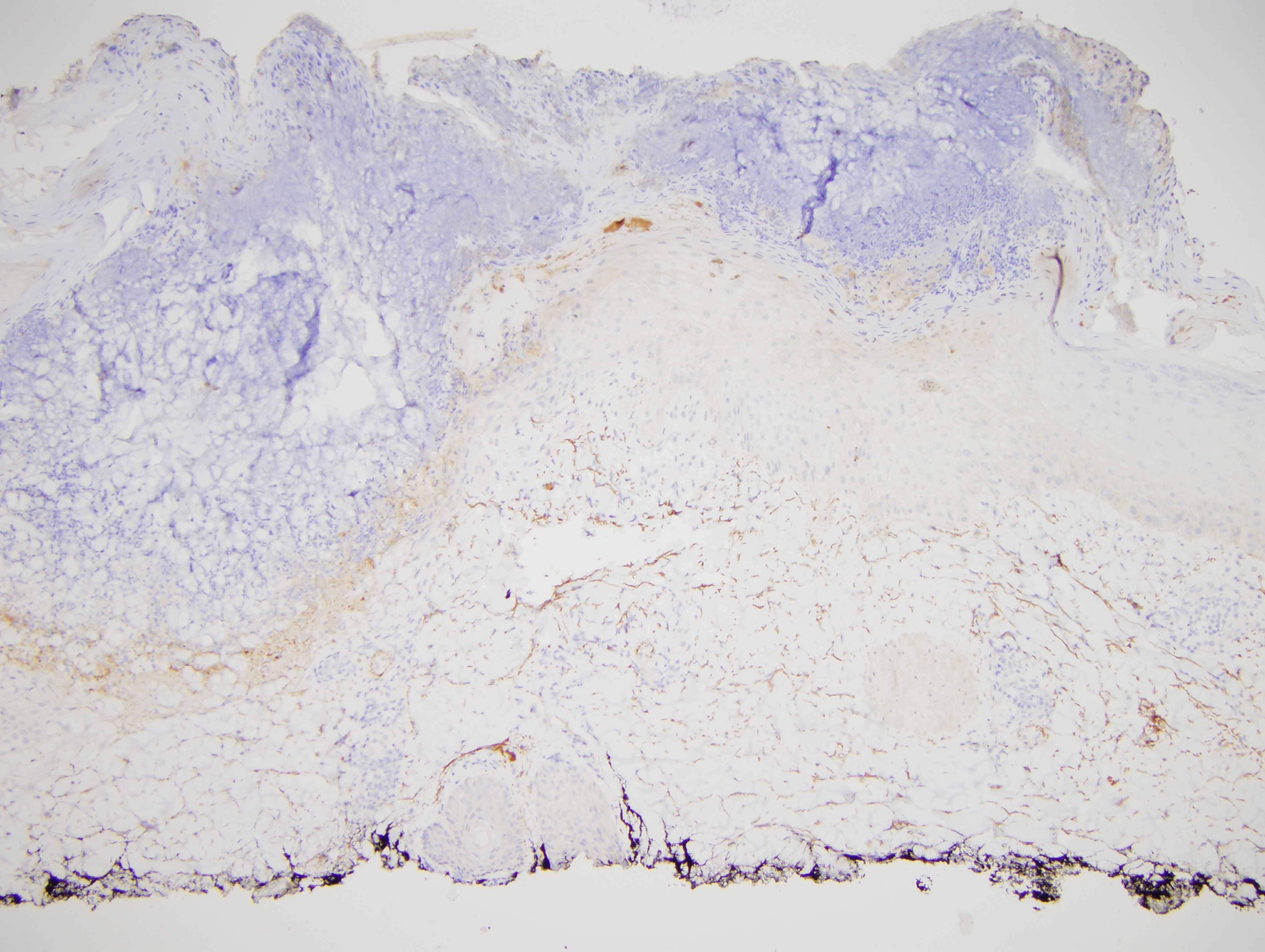 Slide 4: The C3d preparation shows a distinctive pattern of intercellular staining involving the lower third of the epidermis.