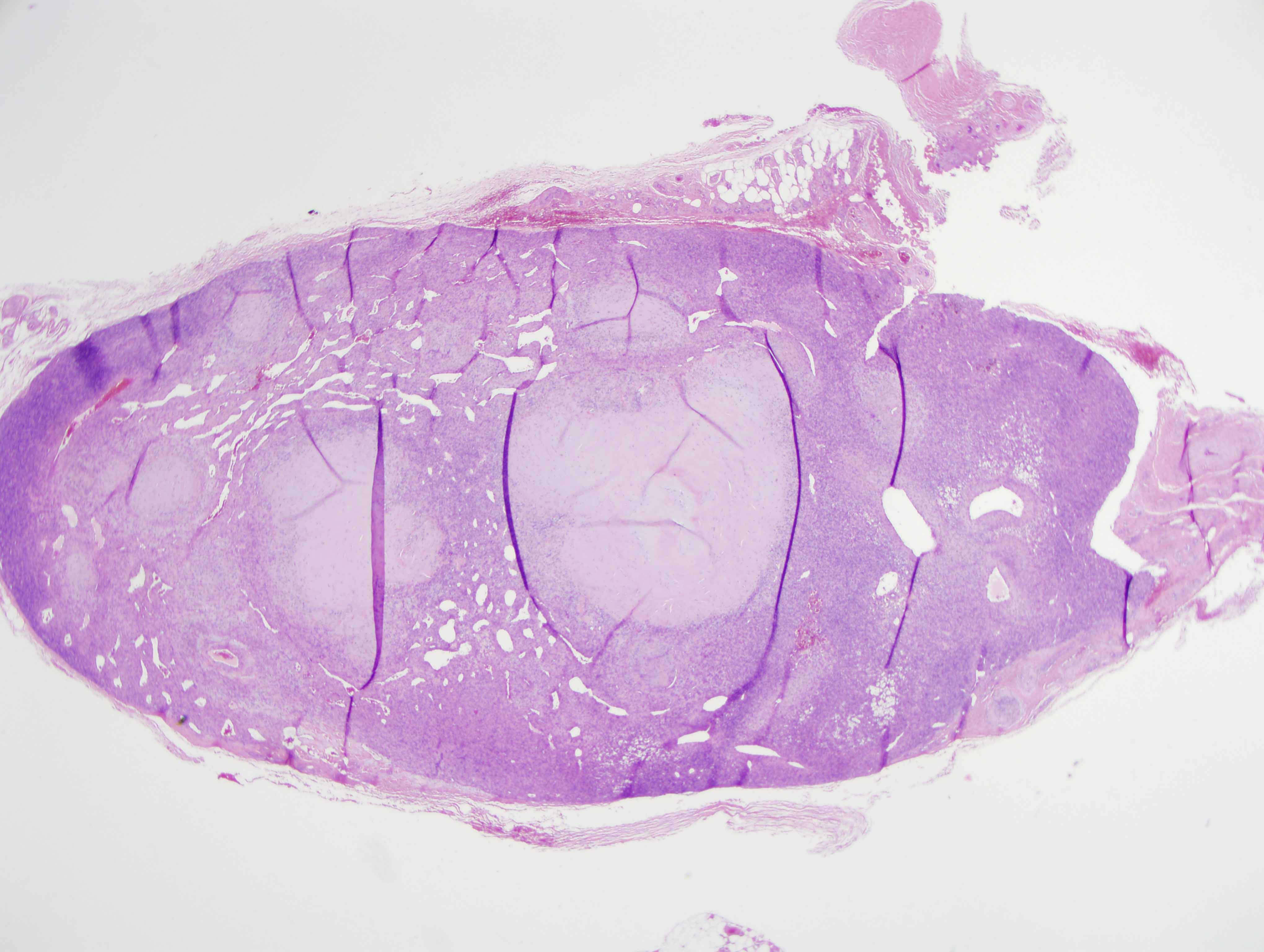Slide 1: The excision specimen shows a circumscribed nodular tumor that has a biphasic pattern characterized by discrete foci that are hyalinized to basophilic and somewhat chondroid in quality.