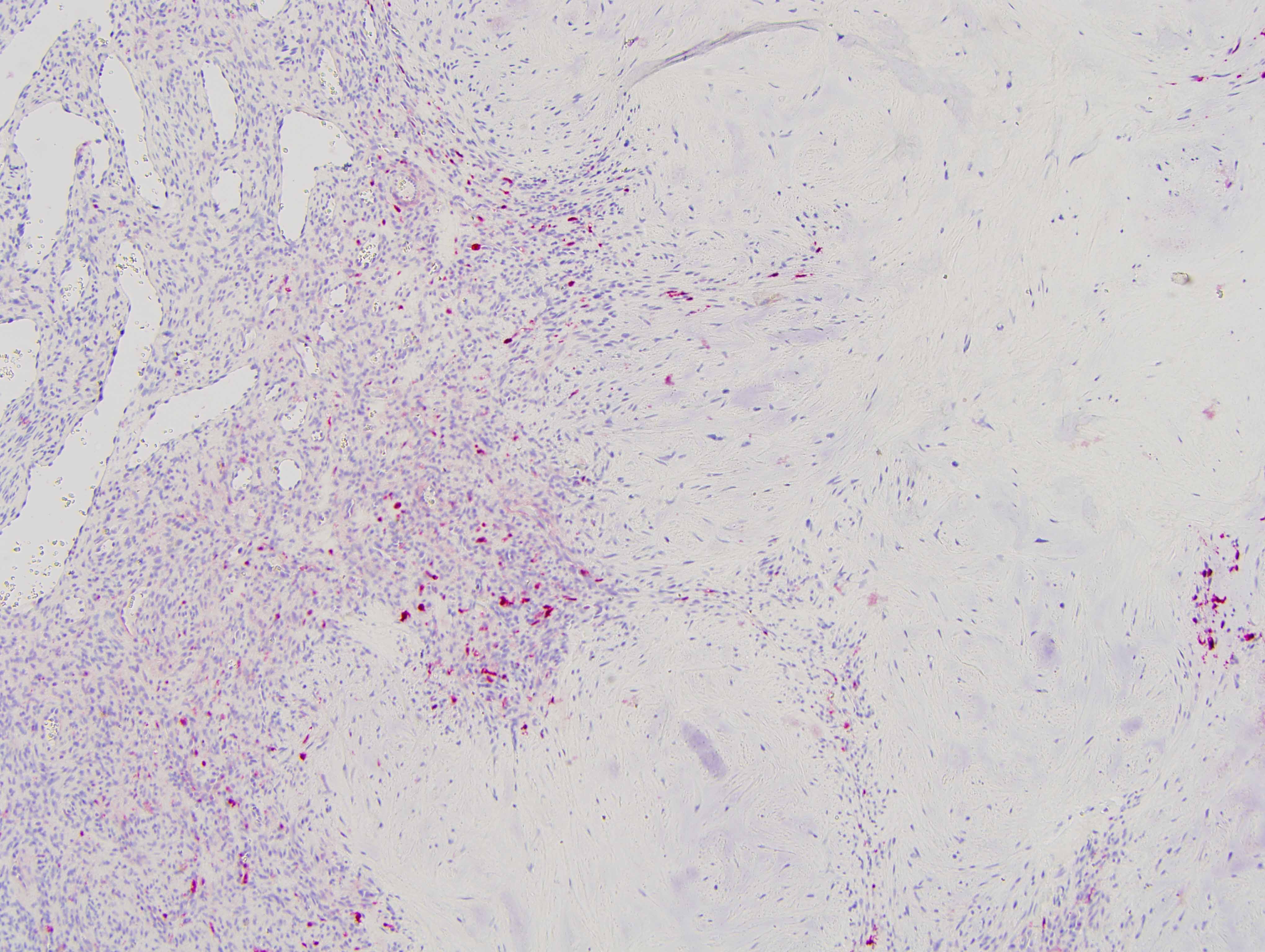 Slide 7: There are a smattering of S-100 positive appearing cells throughout the lesion.