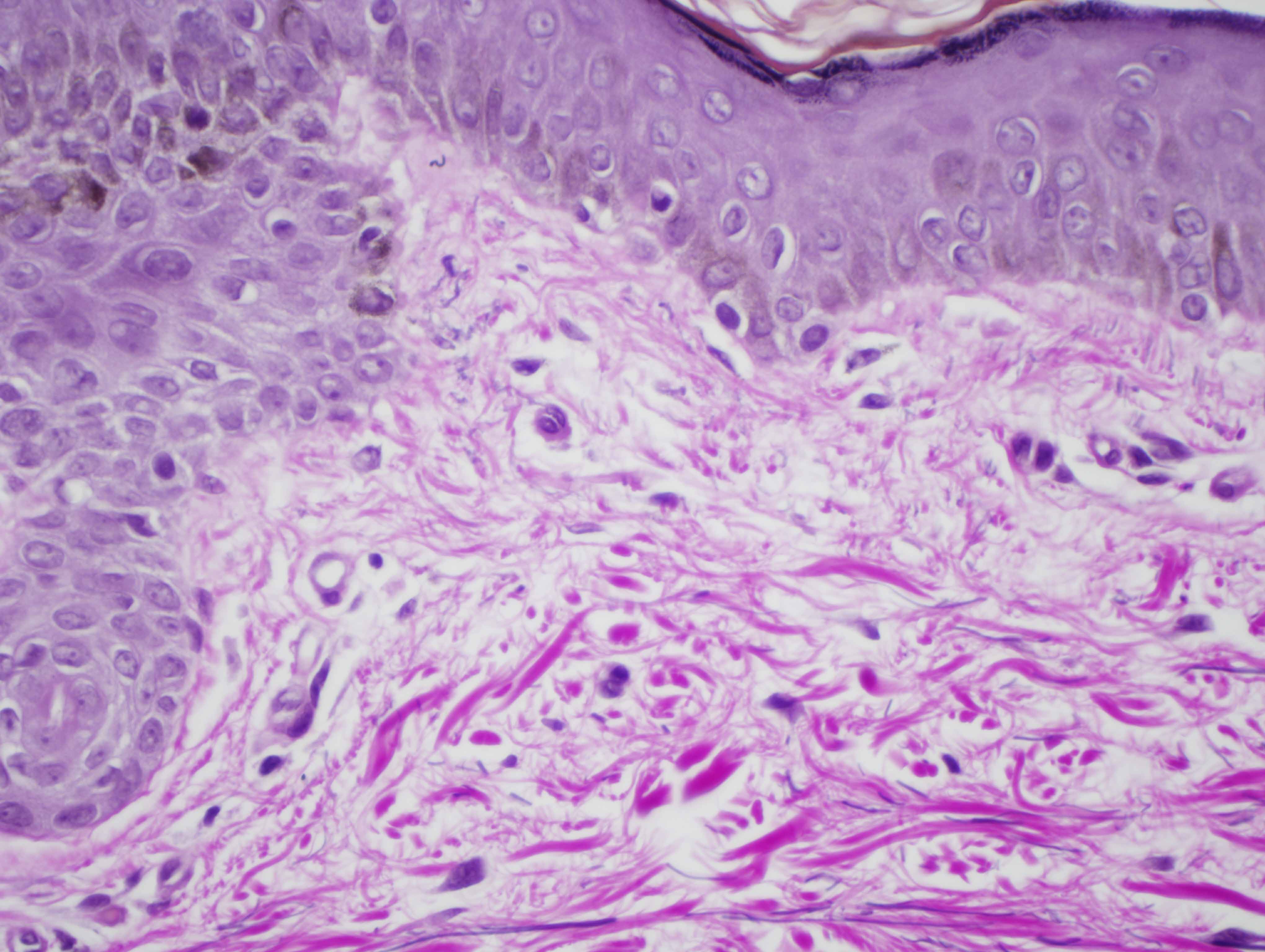 Slide 5: The Elastic tissue stain shows a very striking pattern of papillary dermal elastolysis. There is only a minimal residual oxytalan and elaunin elastic fiber plexus.