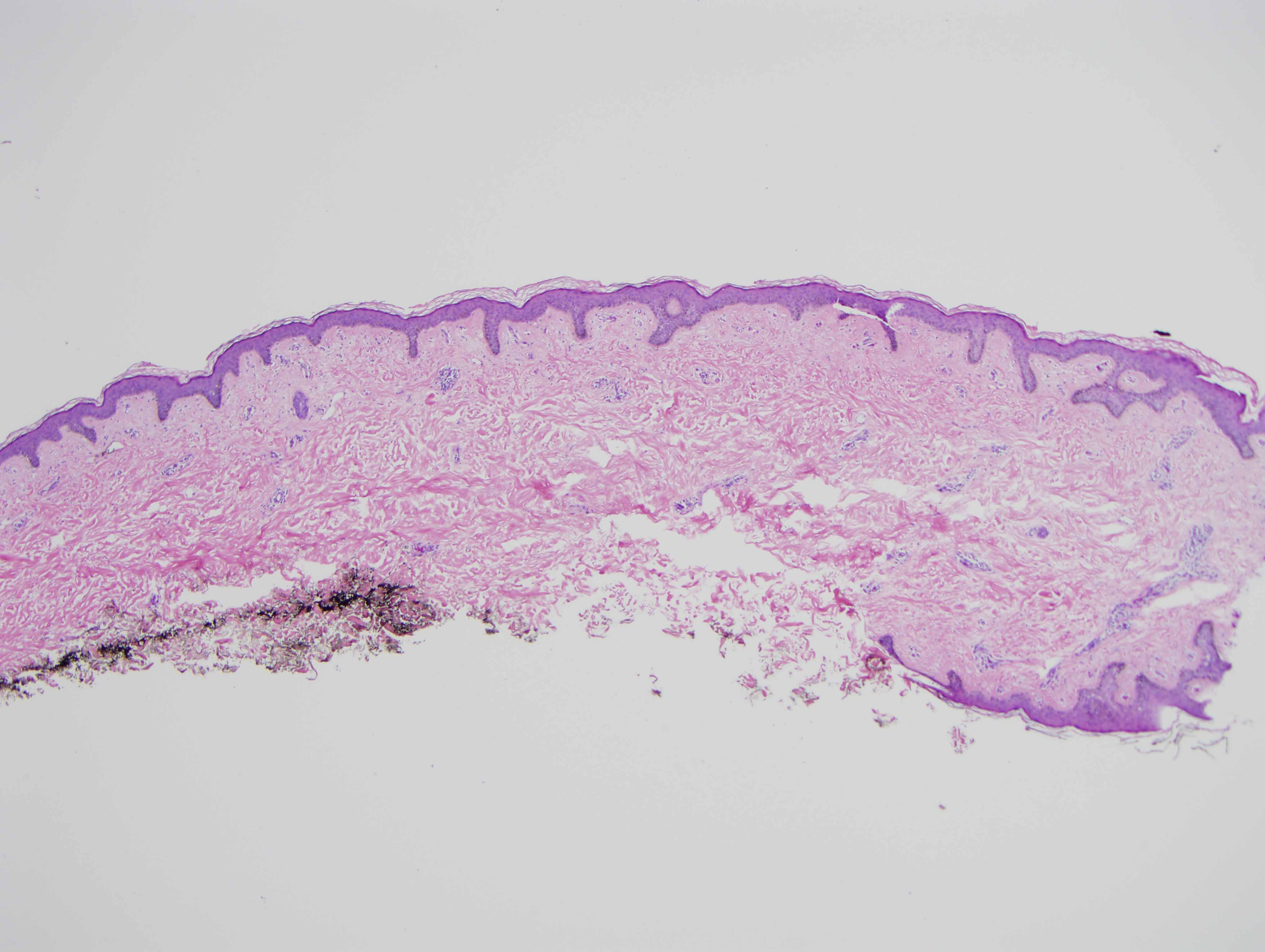 Slide 1: The bisected excision specimen shows a somewhat attenuated epidermis.