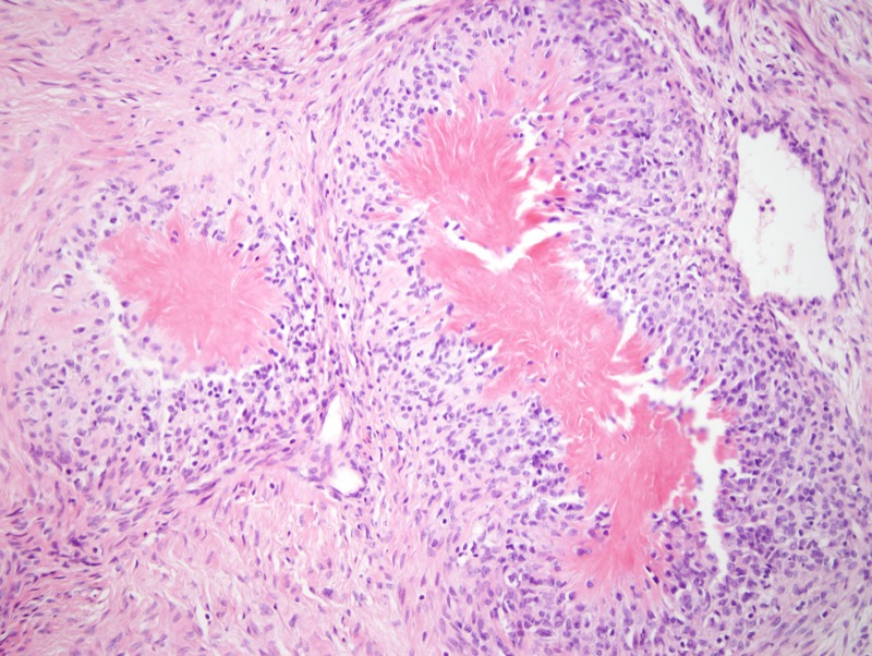 Benign cancer of smooth muscle