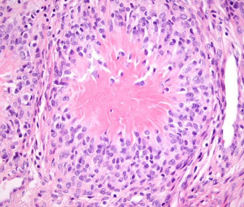 Slide 5: High power view of a collagen rosette showing the surrounding ovoid cells with clear to eosinophilic cytoplasm, minimal pleomorphism and atypia and no mitotic activity.