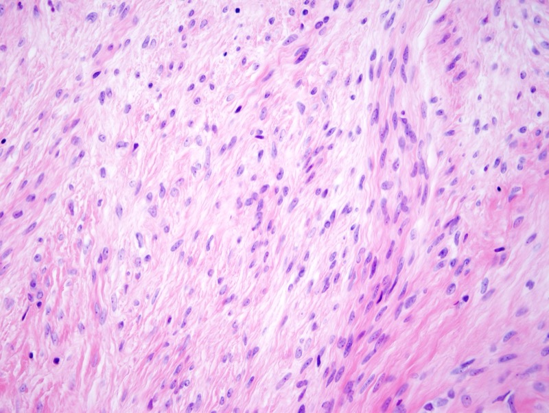 Slide 6: The spindled areas are of relatively low cellularity and are composed of bland spindled cells with oval nuclei, and small nucleoli. The cells are minimally pleomorphic with rare mitoses. The stroma ranges from fibrous to myxoid.