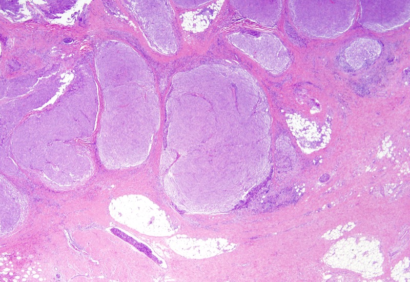 Slide 1: 52 year old woman with a history of Castleman's disease presenting with a 5 cm abdominal wall mass.<br><br>Low power examination reveals a multinodular tumoral growth involving fibroadipose tissue.
