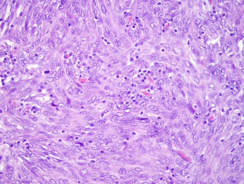 Slide 4: The tumor cell nuclei range from vesicular to having fine granular chromatin. Nucleoli are present but not conspicuous. The cytoplasm is eosinophilic and moderate in amount. Small lymphocytes are present infiltrating between the tumor cells. Mitotic activity was very focal and did not exceed 2/10 high power fields.