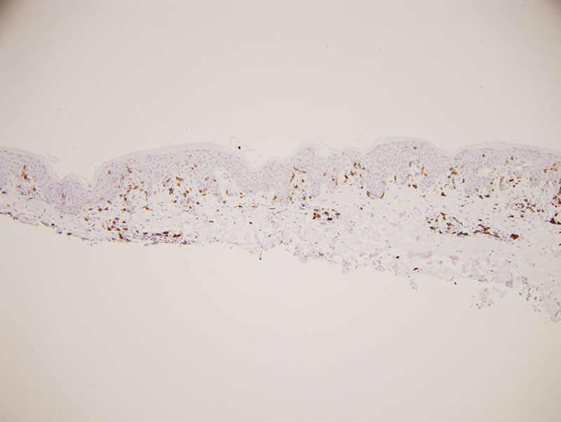 Slide 5: The CD8 preparation highlights a number of lymphocytes in the epidermis and dermis but once again there are many lymphocytes that are not positive for CD8 in the epidermis. Collectively the extent of staining for CD4 and CD8 compared to CD3 would suggest that there are lymphocytes within the epidermis that are double negative for CD4 and CD8. The overall intraepidermal CD4 to CD8 ratio is roughly 2:1 while the dermal CD4 to CD8 ratio is in the 4:1 realm.