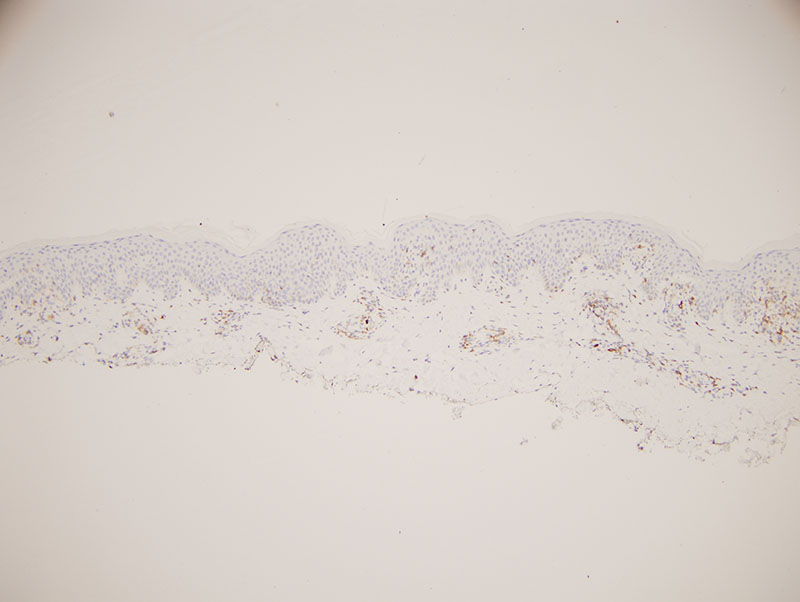 Slide 6: A CD7 preparation shows a significant decrement in staining. The reduction is both in regards to the lymphocytes in the epidermis and those within the dermis. The estimated intraepidermal reduction is in the 80% realm while in the dermis it is in the 80-90% realm.