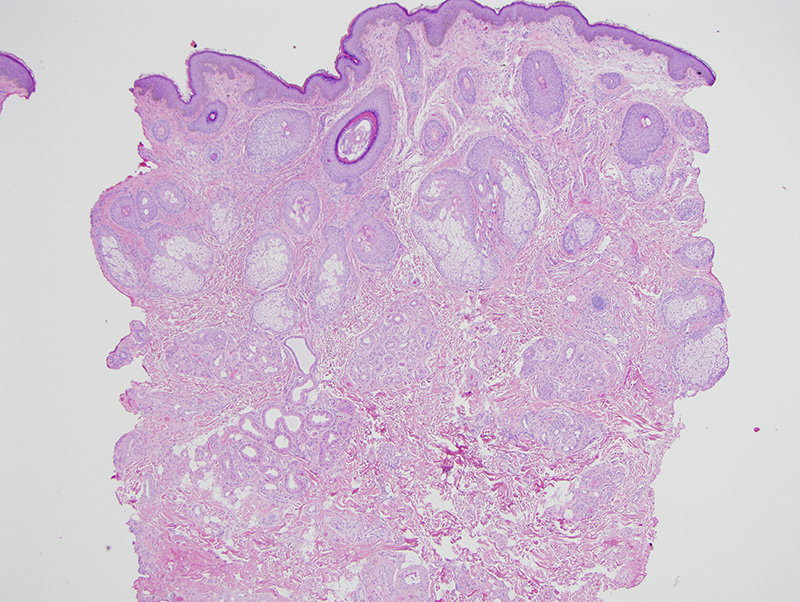 Slide 1: This generous biopsy shows an unusual hamartomatous process within the mid and deeper dermis characterized by hyperplastic eccrine coils exhibiting significant apocrine metaplasia.