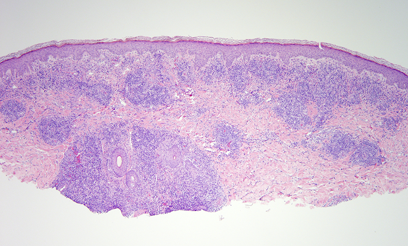 Slide 1: 63 year-old man with a single lesion of the posterior leg.  The biopsy shows a superficial and deep nodular lymphocytic infiltrate.