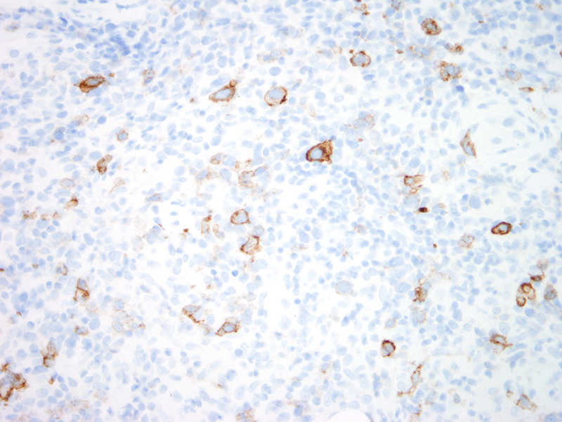 Slide 11: The larger cells which occupy roughly 30-40% of the infiltrate exhibit CD30 positivity.