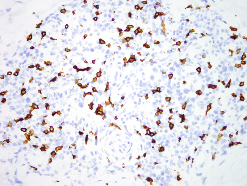 Slide 9: This is the CD8 stain.  The CD4 to CD8 ratio is markedly elevated and is in excess of 10:1 clearly indicative of CD4+ T cell lymphoproliferative disease.
