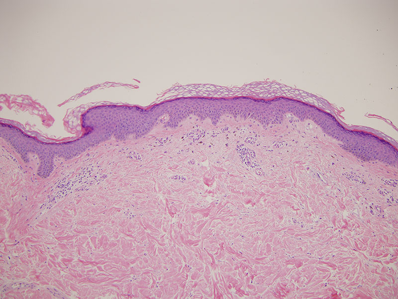 Slide 1: The epidermis is attenuated. There are scattered dyskeratotic cells unaccompanied by lymphocyte satellitosis. Cytoid bodies are also transepidermally eliminated into the stratum corneum.