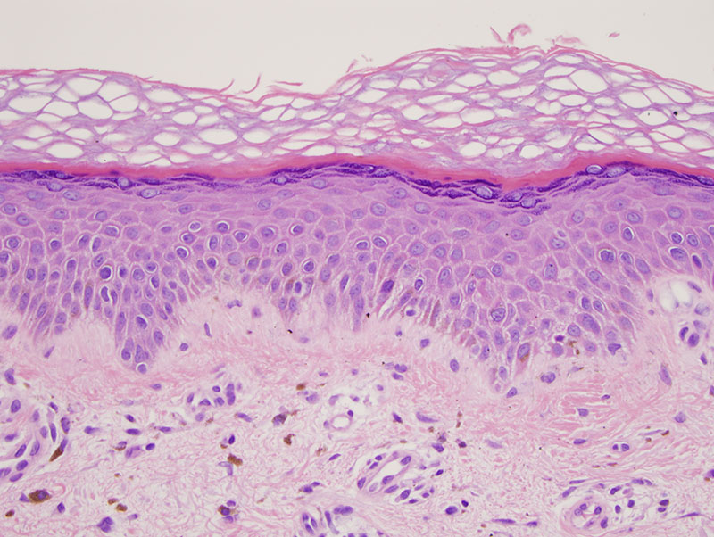 Slide 2: At higher power, one can appreciate the melanophages within the superficial corium. There is evidence of amyloid within the papillary dermis derived from the apoptotic keratinocytes.