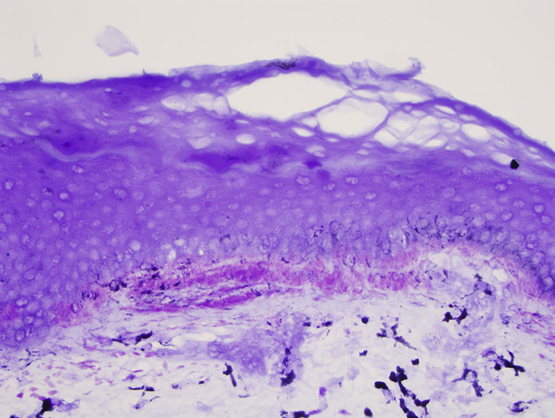 Slide 3: The amyloid deposits are highlighted by the Crystal Violet preparation.