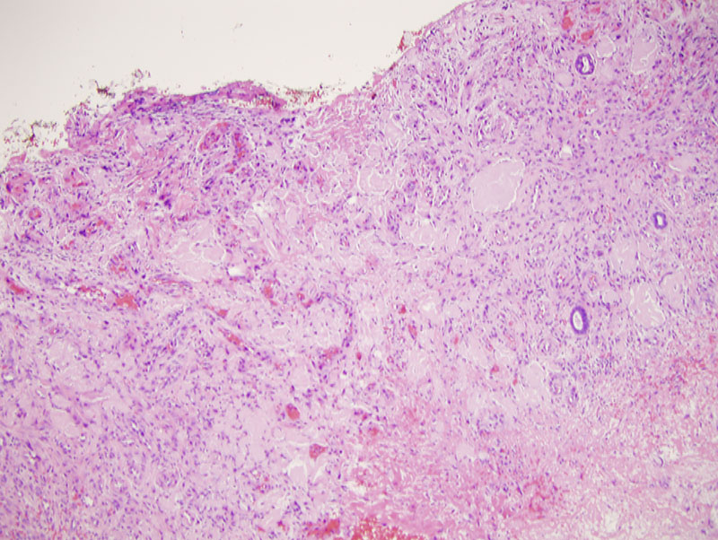 Slide 2: There is a foreign body response to polarizable material. A very striking feature in the biopsy is eosinophilic precipitates present within the corium. They assume a rounded globular morphology.