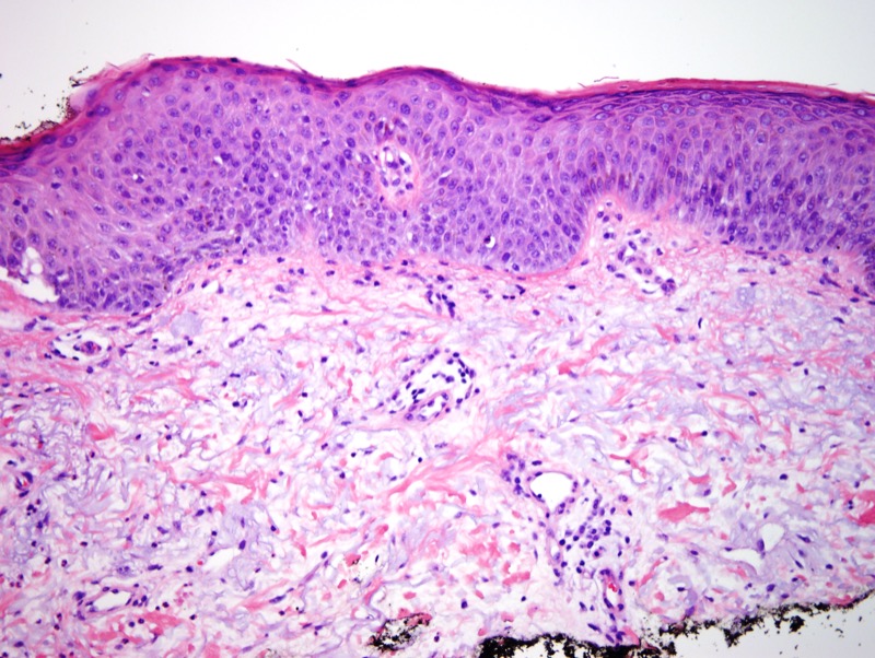 Slide 3: Closer inspection reveals an atypical melanocytic lesion characterized by dysplastic epithelioid melanocytes exhibiting a single cell and abortive dyshesive nested growth pattern along the dermal-epidermal junction.