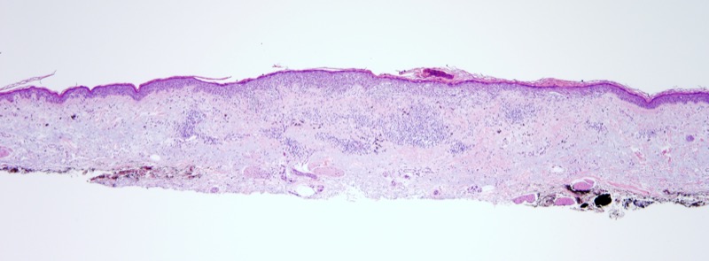 Slide 1: 70 year old man with an upper arm lesion.
