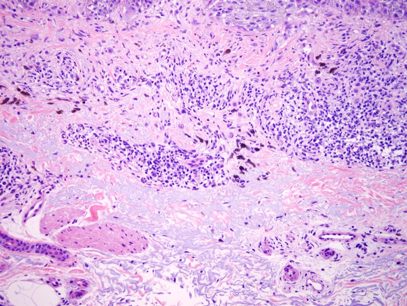 Slide 3: In addition, however, there are areas of invasive melanoma as well characterized by singly disposed malignant epithelioid melanocytes that percolate through a fibrotic and inflamed dermis.  The invasive melanoma extends for a Clark level III. However, the regressive stromal changes exceed the depth of tumor invasion.