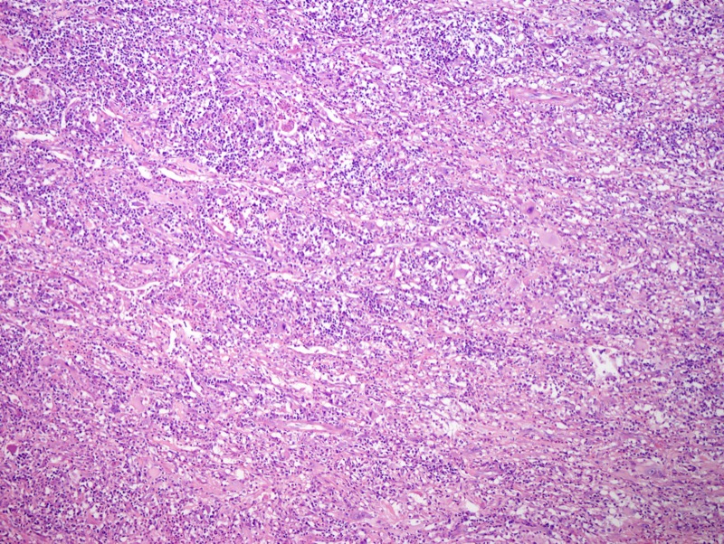 Slide 2: The tumor is characterized by a background of marked inflammation including sheets of plasma cells, many neutrophils as well as lymphocytes with a background of neovascularization and variable fibrosis.