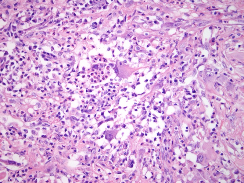 Slide 5: These histiocytes are predominantly mononuclear having voluminous cytoplasms whereby the cytoplasms have a biphasic tinctorial quality characterized by peripheral eosinophilia with more of a perinuclear glassy amphophilic alteration of the cytoplasm.  These cells are very large and exhibit a striking pattern of emperipolesis whereby the ingested inflammatory cells almost obscure the cellular detail. <br><br>Amidst these large histiocytoid cells exhibiting emperipolesis are cells with bizarre nuclear features.  These cells are excessively large with marked nuclear contour irregularities, hyperchromasia and macroeosinophilic nucleolation really exhibiting severe pleomorphism.