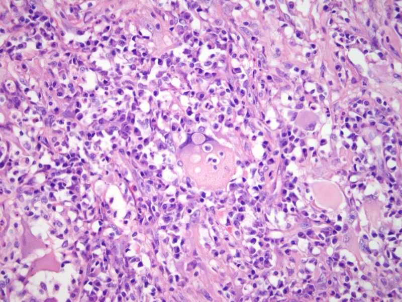 Slide 7: Tumor cells are excessively large with marked nuclear contour irregularities, hyperchromasia and macroeosinophilic nucleolation really exhibiting severe pleomorphism. Emperipolesis is also present.