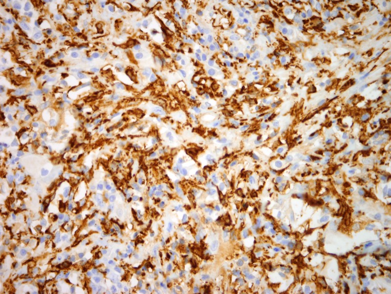 Slide 8: There is extensive immunoreactivity for CD163 (shown here) largely reflecting staining in small reactive lymphocytes however at least a subset of the larger histiocytoid forms exhibiting emperipolesis demonstrates CD163 positivity.  Part of the positive reaction reflects the ingested inflammatory cells. <br><br>The cells are not CD1A positive. They do not stain for CD35.  They are not CD30 positive.