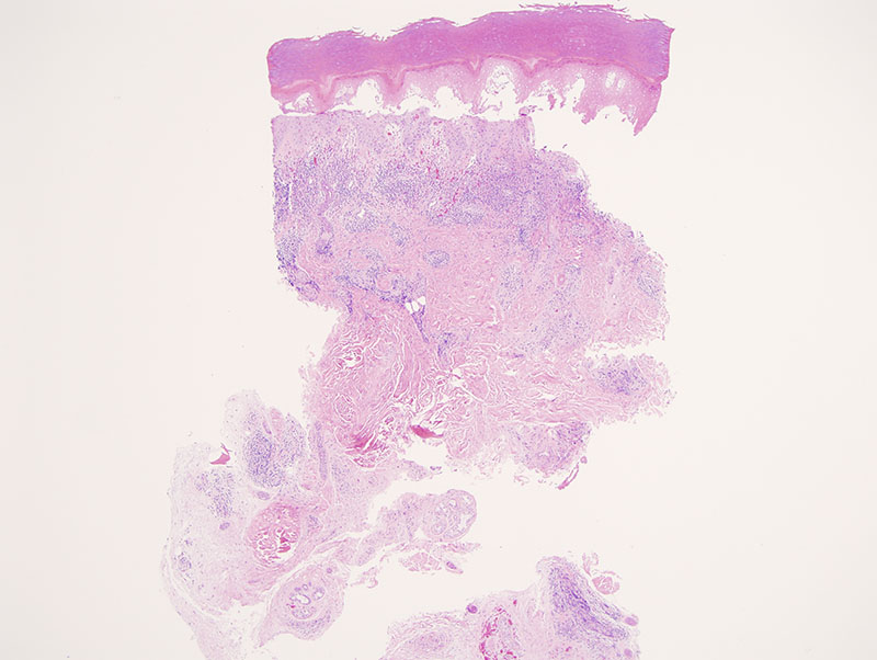 Slide 1: The biopsy in specimen A shows a very striking lymphocytic infiltrate within the dermis. There are abrupt necrolytic alterations of the epidermis likely reflecting ischemia.
