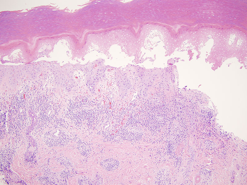 Slide 2: In examining the dermal papillae there is some degree of vascular ectasia with focal fibrin deposition and hemorrhage.
