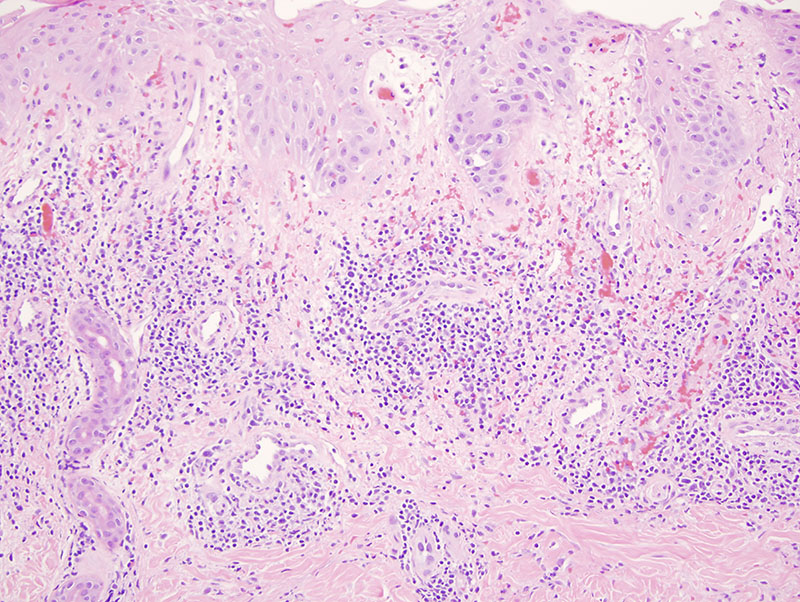 Slide 3: The brunt of the inflammation, however, is truly a dermal one, whereby lymphocytes surround and permeate capillaries and venules of the superficial and deep dermis.