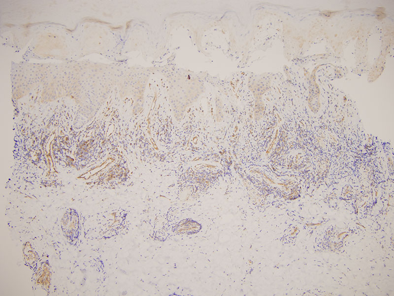 Slide 5: The MXA preparation is markedly up regulated. There is extensive staining in endothelium, inflammatory cells and also within the epidermis.