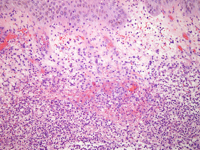 Slide 3: Focally there is the residuum of papillary dermal edema and as well amidst the zones of effacing neutrophilia are vessels exhibiting vasculitic changes. The vessels demonstrate luminal and mural fibrin deposition accompanied by  a variable vasocentric cuff of mononuclear cells. A less dense and more mixed infiltrate comprising neutrophils, lymphocytes and serpentine like histiocytes prevails in the remainder of the reticular dermis.