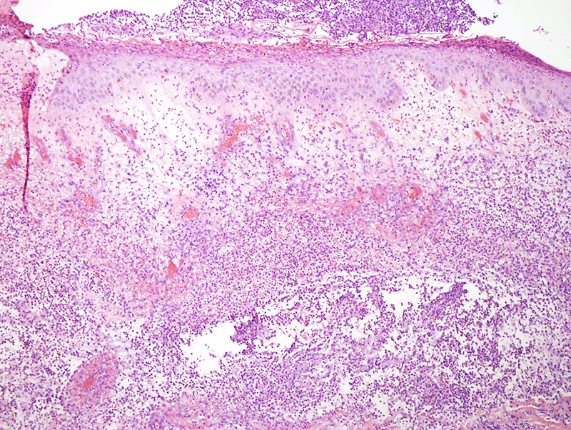 Slide 2: There is diffuse infiltration of the epidermis by neutrophils with attendant epidermal undermining eventuating in focal denudement. The overlying scale is heavily imbued with neutrophils.  The superficial dermis is highly remarkable for a striking pattern of neutrophilic dermolysis whereby seas of neutrophils are associated with disintegration of the connective tissue framework.