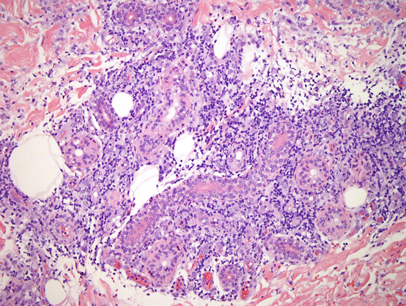 Slide 4: The inflammatory cell infiltrate shows a distinctive tropic tendency to permeate the eccrine ducts and glands and the hair follicle (not shown).