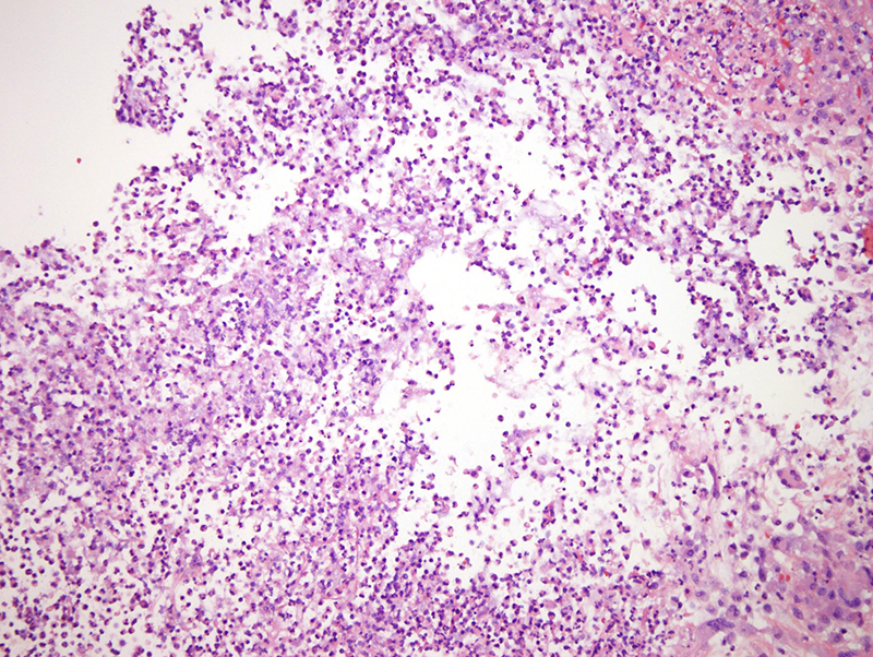 Slide 6: Another image of the superficial dermis which is highly remarkable for a striking pattern of neutrophilic dermolysis whereby seas of neutrophils are associated with disintegration of the connective tissue framework.