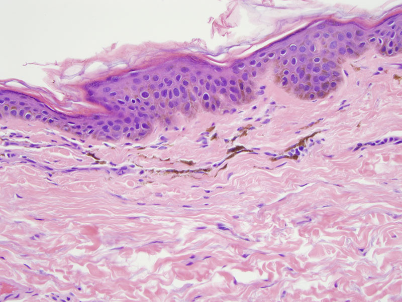 Slide 3: Poikiloderma of Civatte/Riehl's Melanosis