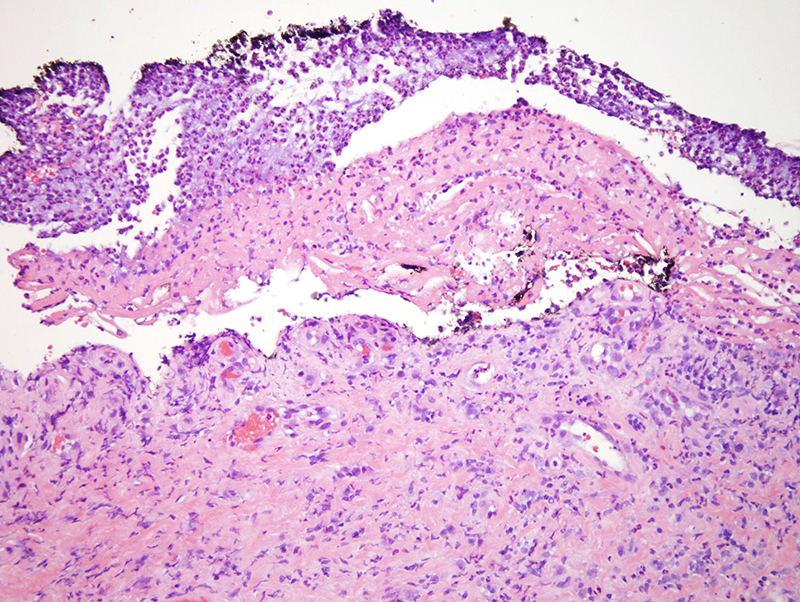 Slide 2: The biopsy is composed exclusively of corium which is remarkable for a granulation tissue response. There is no overlying epithelium as it has been denuded.