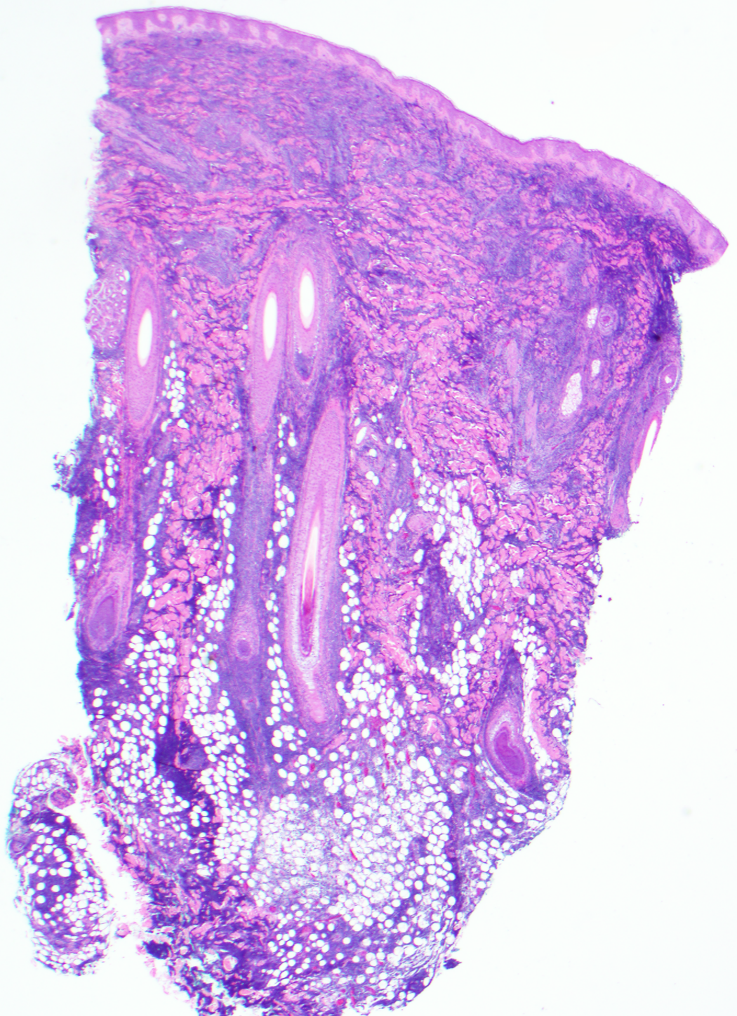Slide 1: Figure 1. 25-year-old man with multiple firm, fixed scalp nodules present for 6–8 months, associated with fatigue, arthralgias, myalgias, and intermittent numbness of the left lower lip. H&E shows a diffuse malignant lymphoid infiltrate involving the dermis and subcutaneous fat (20×).