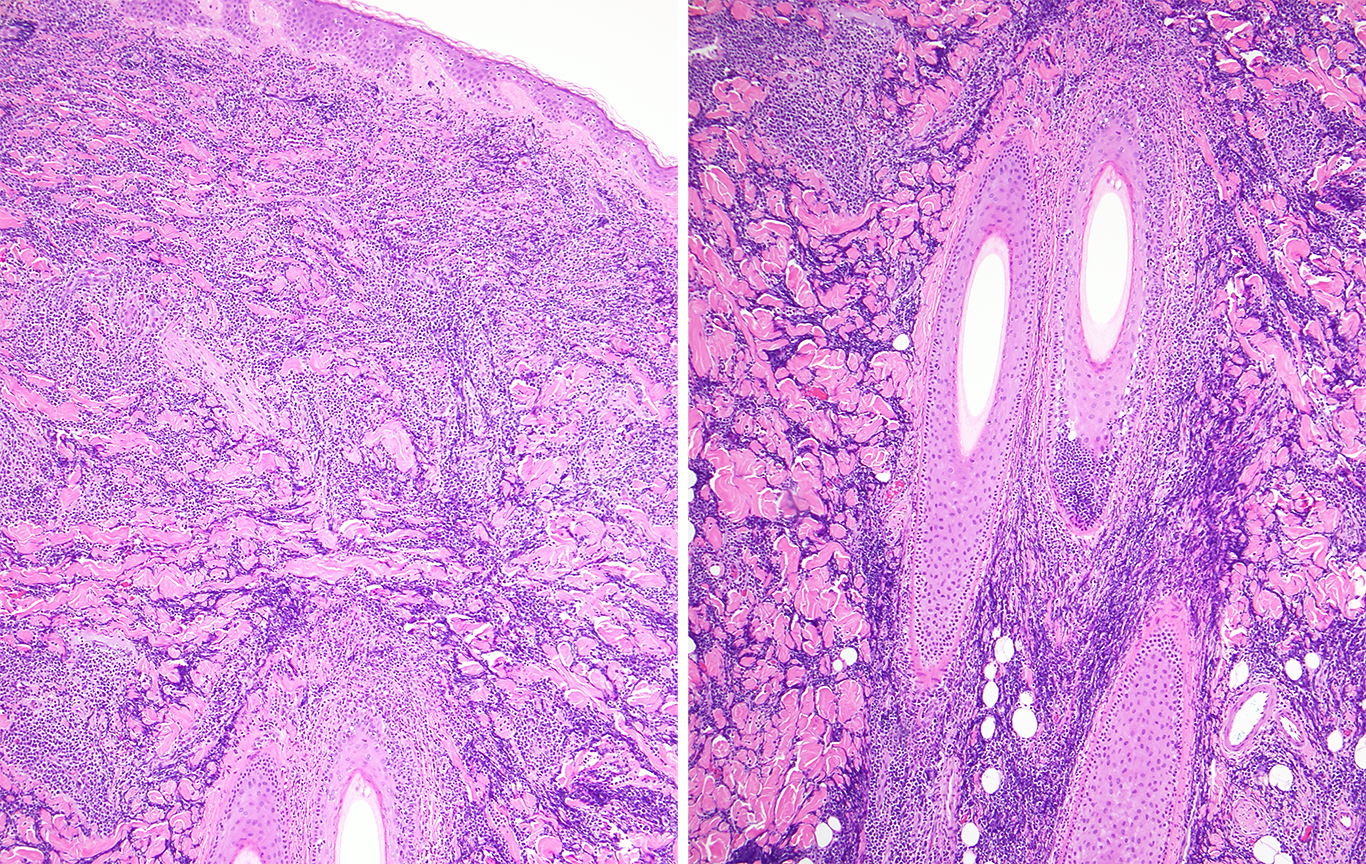 Slide 2: Figure 2. H&E shows a diffuse dermal lymphoblastic infiltrate with focal folliculotropism (arrow), without significant epidermotropism or syringotropism (100×).