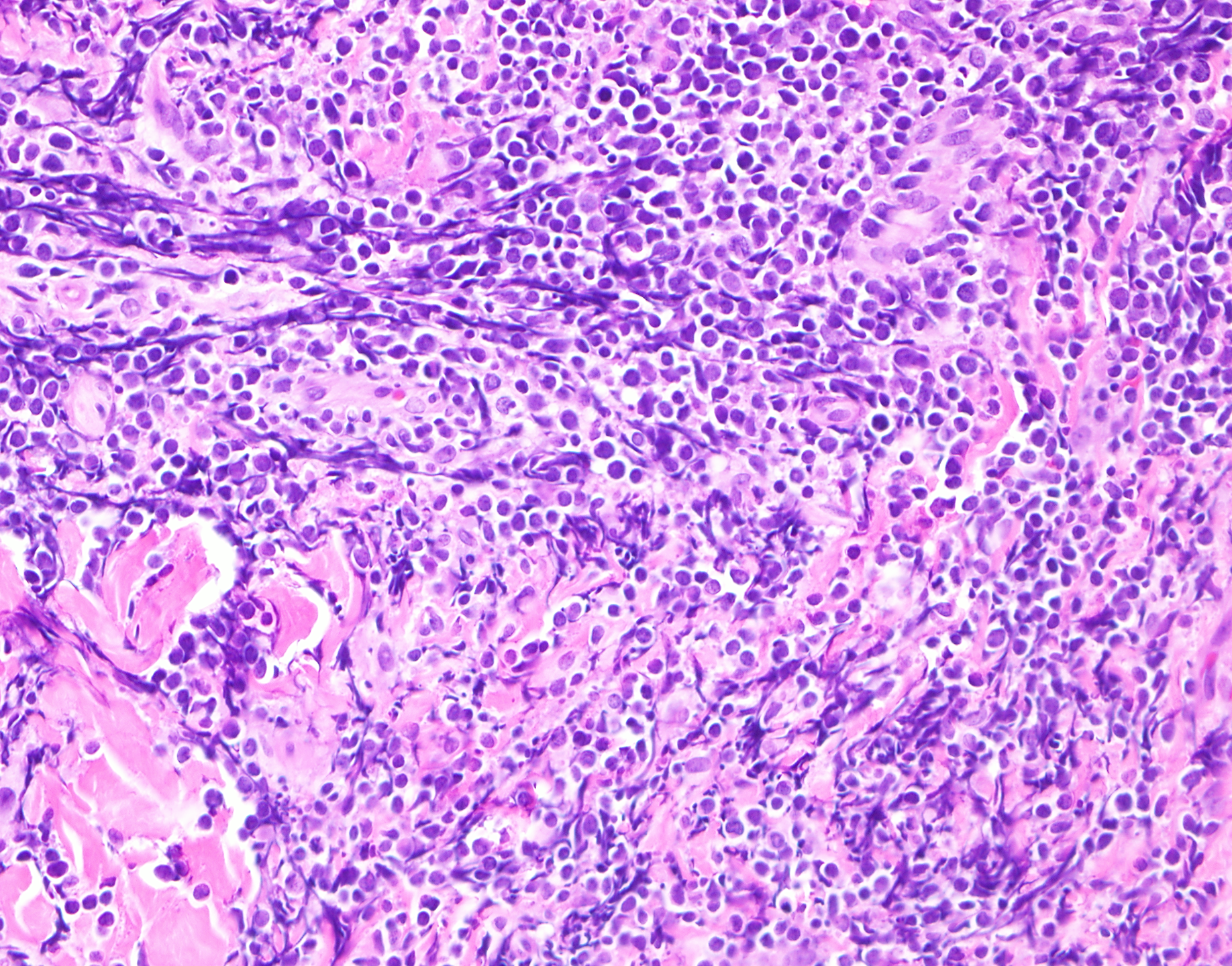 Slide 3: Figure 3. Higher-power H&E shows intermediate to large blastic lymphoid cells with round, non-cerebriform nuclei and scant lightly eosinophilic cytoplasm (400×).