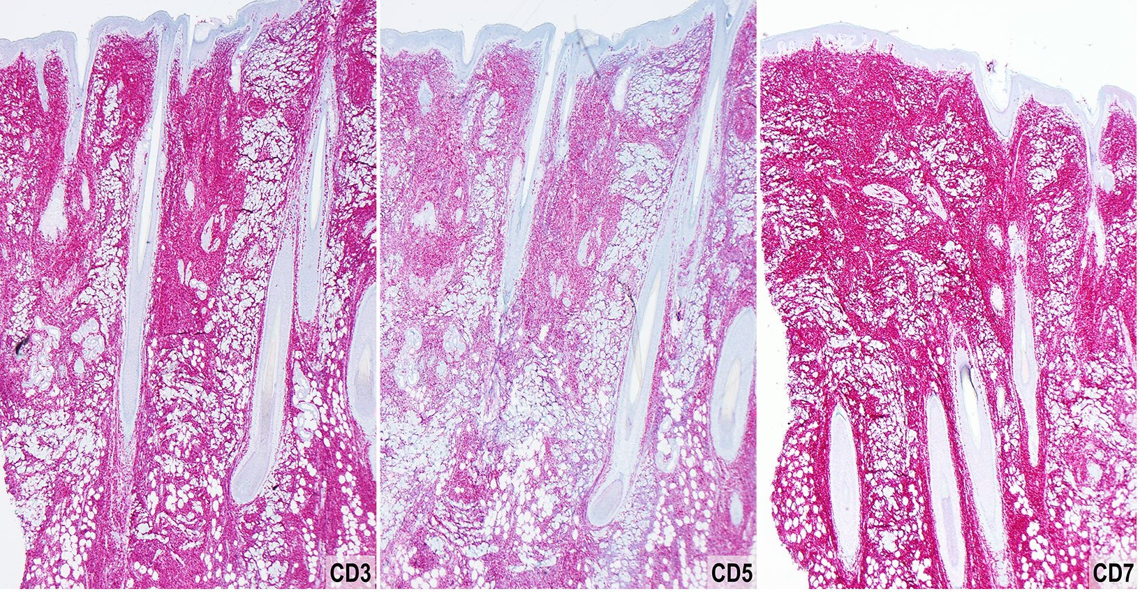 Slide 4: Figure 4. The neoplastic cells are diffusely positive for the T-cell markers CD3, CD5, and CD7 (40×).